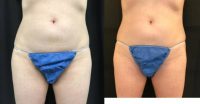 54 year old woman treated with Emsculpt