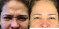 55-64 year old woman treated with Botox for frown lines