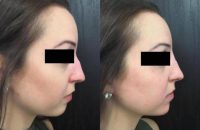 28 year old female treated with Injectable Fillers