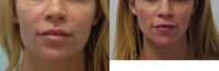 33-year-old woman treated with Jawline Contouring