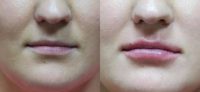 25-34 year old woman treated with Vollbella for Lip Augmentation