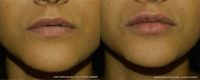 25-34 year old woman treated with hyaluronic acid injections to the lips