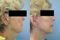 Woman, fillers used to lift cheeks