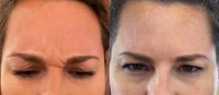 25-34 year old woman treated with Botox Cosmetic