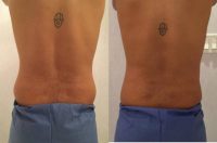 coolsculpting on love handles before and after pic