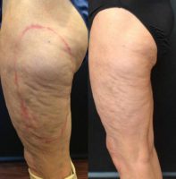 55-64 year old woman treated with truSculpt 3D