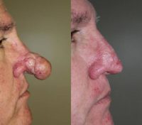 55-64 year old man treated with Nose Surgery