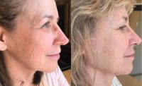 55-64 year old woman treated with Restylane Silk