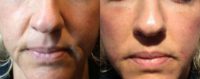 35-44 year old woman treated with Bellafill