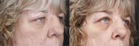 45-54 year old woman treated with Eyelid Surgery (Upper Blepharoplasty)