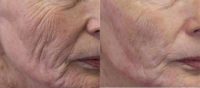 73 year old woman treated with PDO Thread Lift