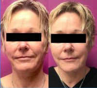 45-54 year old woman treated with Bellafill