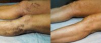 35-44 year old woman treated with Sclerotherapy