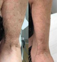 65-74 year old woman treated with Exilis