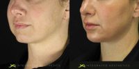 35-44 year old woman treated with Chin Filler