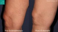 35-44 year old woman treated with Sclerotherapy