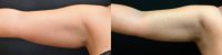 25-34 year old woman treated with Laser Liposuction for Arms