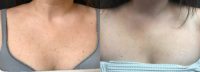 Sun Damage Removal on Chest with 1 Session of Fraxel+VBeam