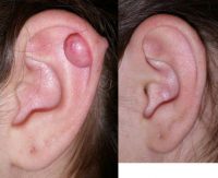 Removal of Keloid Scar on Ear