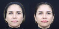 48 year old woman treated with Restylane Kysse