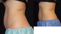 35-44 year old woman treated Lower Abdomen and Hips with CoolSculpting