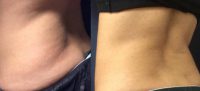 35-44 year old woman treated with SculpSure