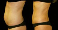 25-34 year old woman treated with Liposuction