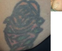 44 year old woman treated with Tattoo Removal with PicoWay System
