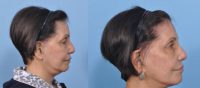 65-74 year old woman treated with FaceTite