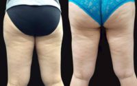 45 year old woman treated with Laser Liposuction