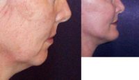 45-54 year old woman treated with Chin Surgery