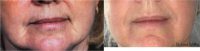 55-64 year old woman treated with Restylane Refyne