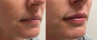 Lip enhancement with Restylane