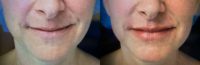 35-44 year old woman treated with Restylane Silk
