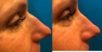 35-44 year old woman treated with Nonsurgical Nose Job