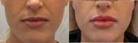 25-34 year old woman treated with Lip Augmentation