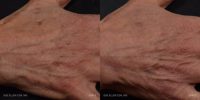 65-74 year old woman treated with Fraxel Laser to Hands