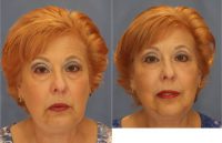 65-74 year old woman treated with Lower Eyelid Surgery