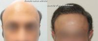 Baldness Correction and Beard Hair Grafts