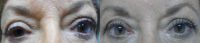 Ptosis Eyelid Repair