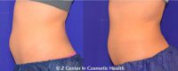 18-24 year old woman treated with CoolSculpting to the Belly
