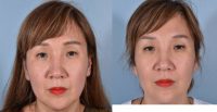 45-54 year old woman treated with Restylane Defyne to her nasolabial folds