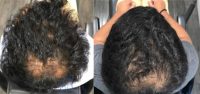 35-44 year old man treated with Hair Loss Treatment