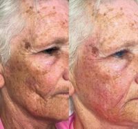Woman treated with Sculptra Aesthetic