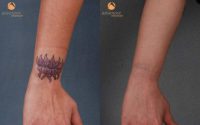 Female Treated with Q-Switched Laser (1064nm and 532nm) for the Removal of Tattoo