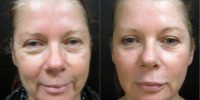 Facial Resurfacing - C02 Laser