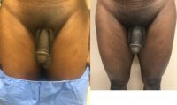 35-44 year old man treated with Penis Enlargement