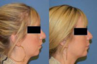 25-34 year old woman treated with Chin Augmentation (nonsurgical)