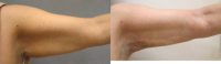 Get Toned Arms with Liposuction