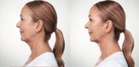55-64 year old woman treated with Kybella